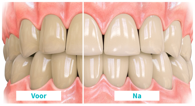 Opalescence Toothpaste Before and After